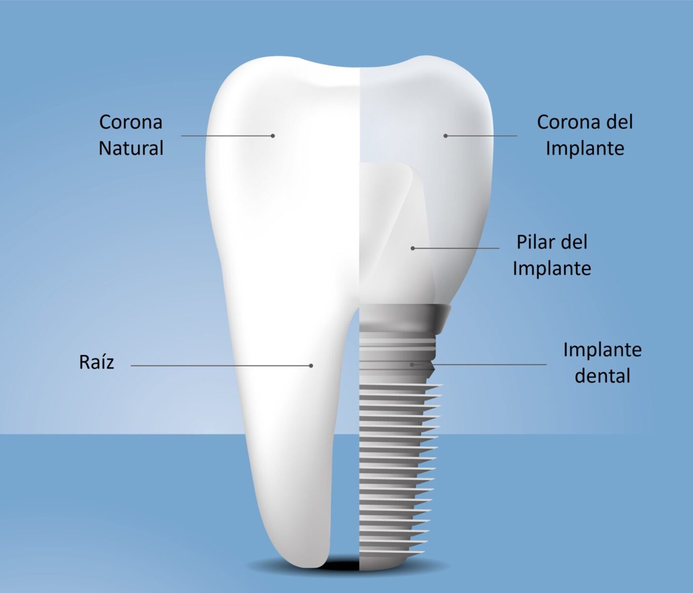 Cómo es un implante dental Clínicas Dentales Corró Maduro Panamá