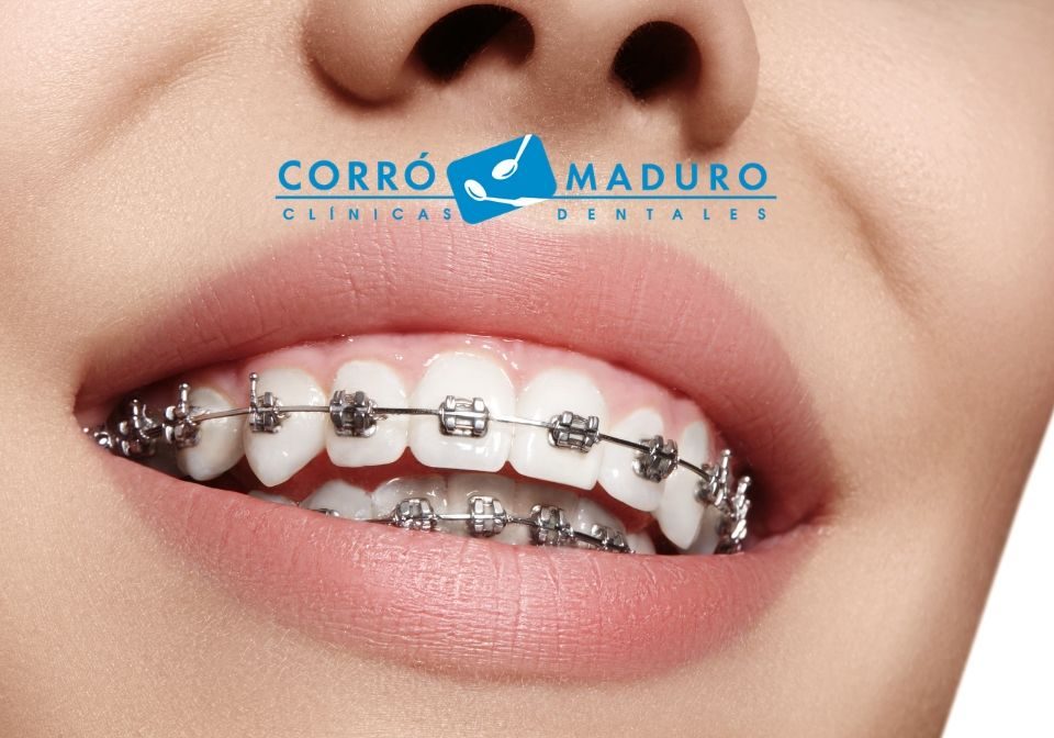 Frenos Archivos Clinicas Dentales Corro Maduro Panama