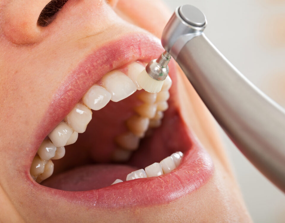 limpieza-dental