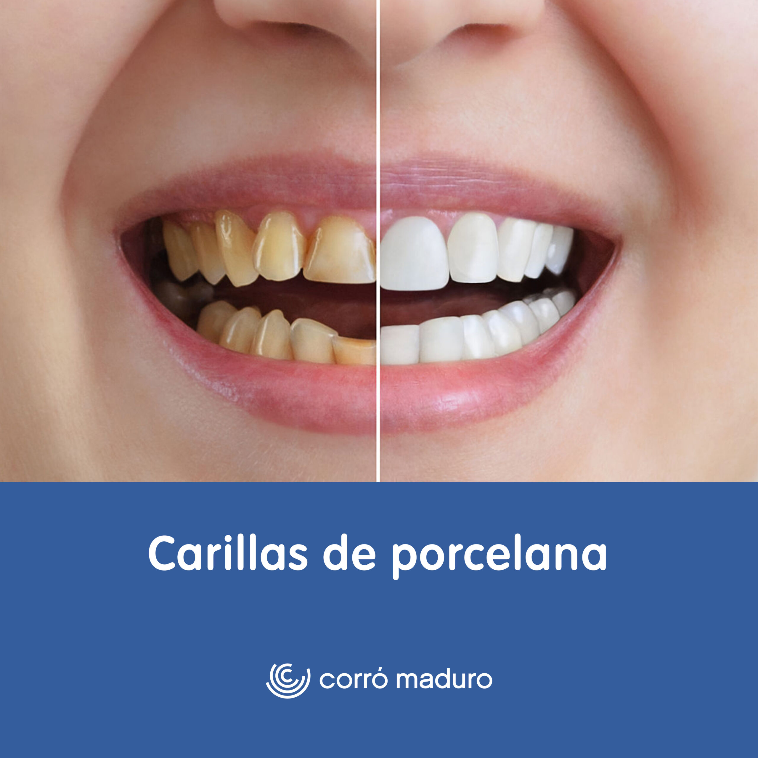 Carillas de porcelana por unidad desde